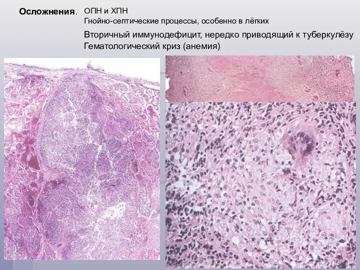 Осложнения. ОПН и ХПН Гнойно-септические процессы, особенно в лёгких Вторичный иммунодефицит,