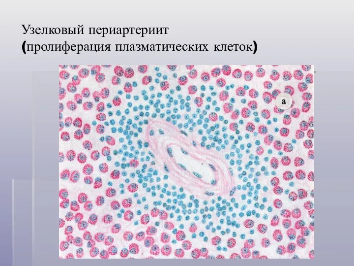 Узелковый периартериит (пролиферация плазматических клеток)