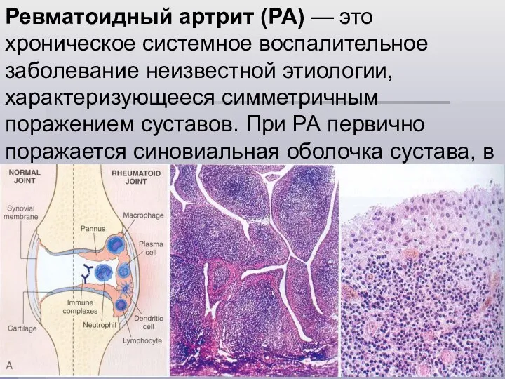 Ревматоидный артрит (РА) — это хроническое системное воспалительное заболевание неизвестной этиологии,