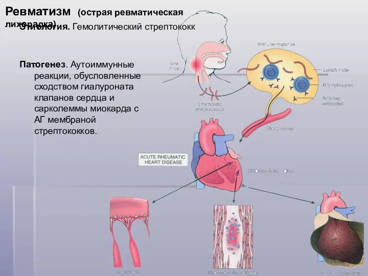 Ревматизм (острая ревматическая лихорадка) Этиология. Гемолитический стрептококк Патогенез. Аутоиммунные реакции, обусловленные