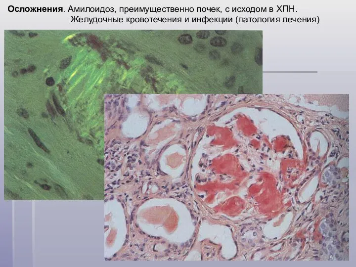 Осложнения. Амилоидоз, преимущественно почек, с исходом в ХПН. Желудочные кровотечения и инфекции (патология лечения)