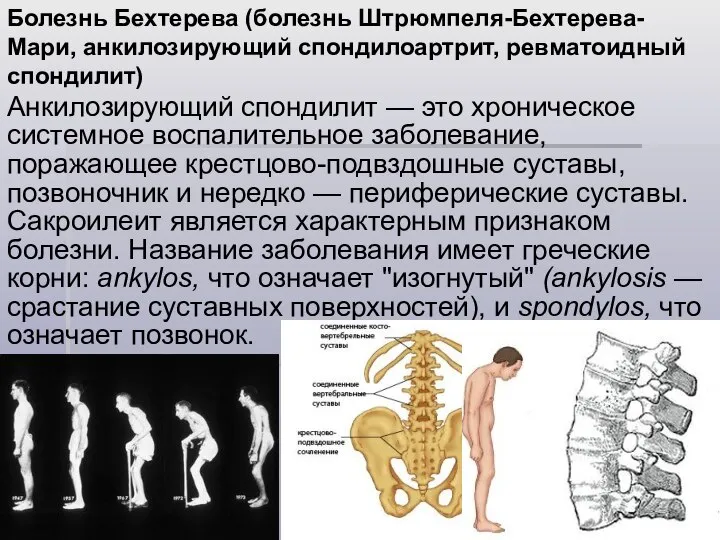 Анкилозирующий спондилит — это хроническое системное воспалительное заболевание, поражающее крестцово-подвздошные суставы,