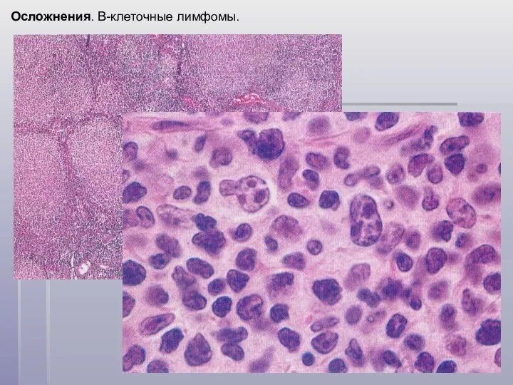 Осложнения. B-клеточные лимфомы.