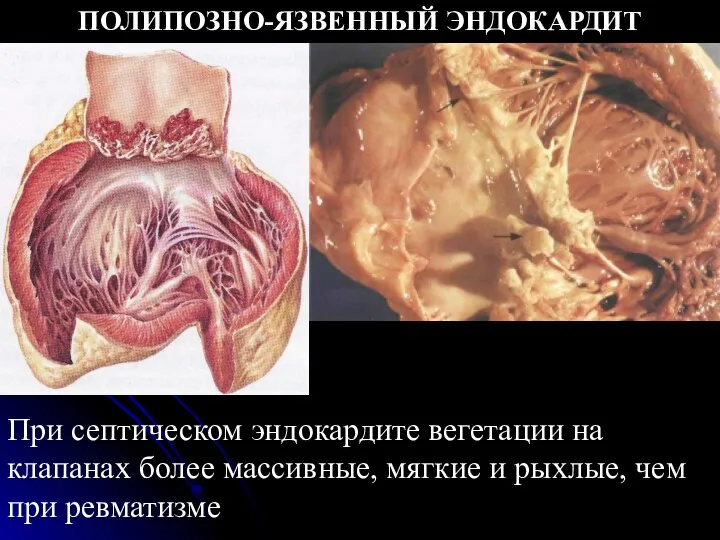 ПОЛИПОЗНО-ЯЗВЕННЫЙ ЭНДОКАРДИТ При септическом эндокардите вегетации на клапанах более массивные, мягкие и рыхлые, чем при ревматизме