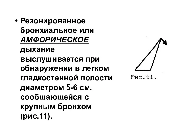 Резонированное бронхиальное или АМФОРИЧЕСКОЕ дыхание выслушивается при обнаружении в легком гладкостенной