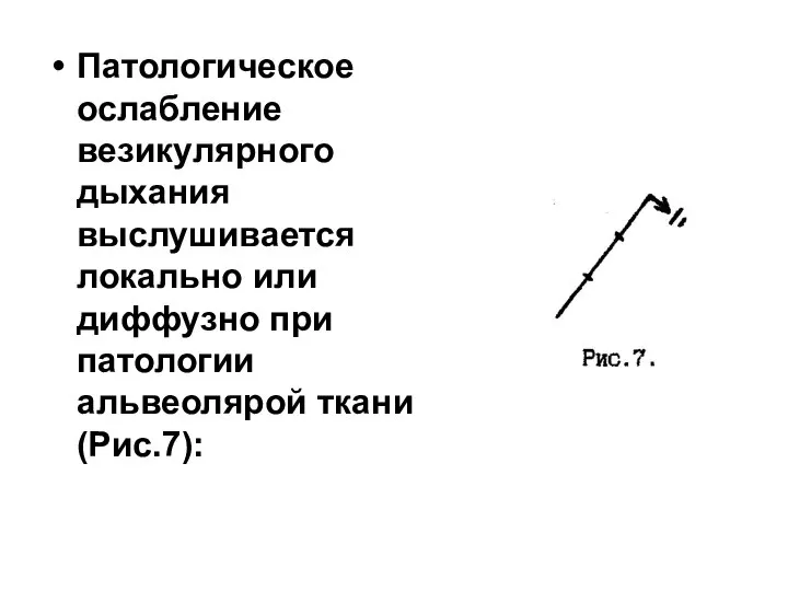 Патологическое ослабление везикулярного дыхания выслушивается локально или диффузно при патологии альвеолярой ткани (Рис.7):