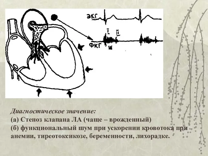 Диагностическое значение: (а) Стеноз клапана ЛА (чаще – врожденный) (б) функциональный