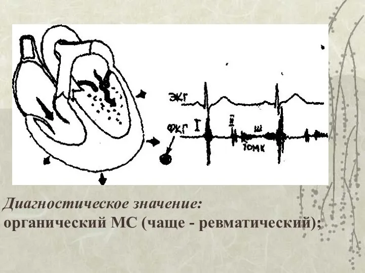 Диагностическое значение: органический МС (чаще - ревматический);