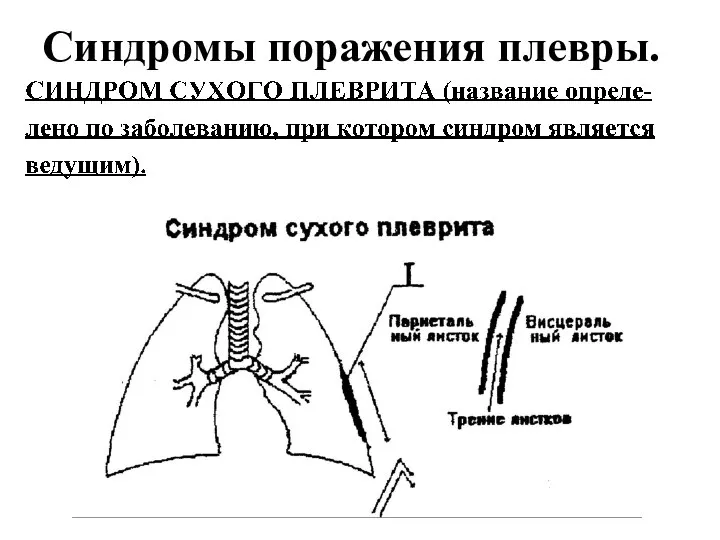 Синдромы поражения плевры.