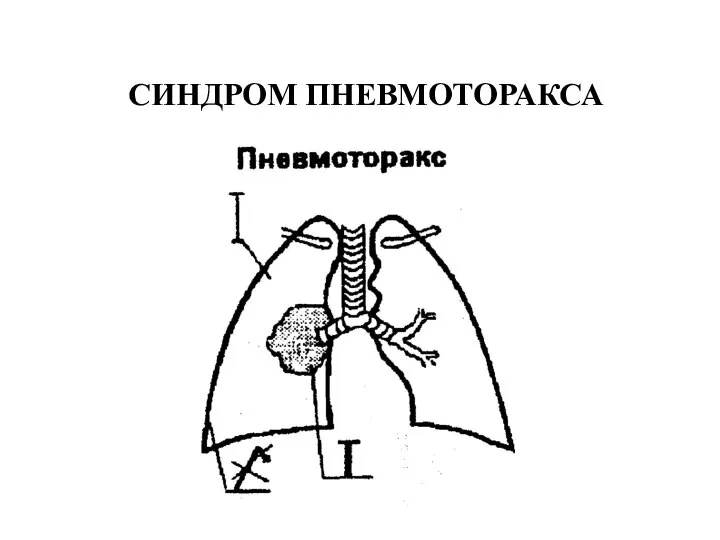 СИНДРОМ ПНЕВМОТОРАКСА