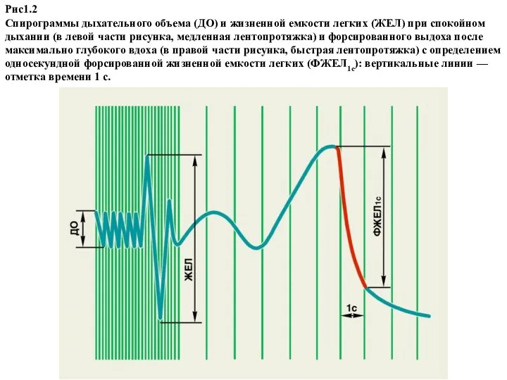 Рис1.2 Спирограммы дыхательного объема (ДО) и жизненной емкости легких (ЖЕЛ) при