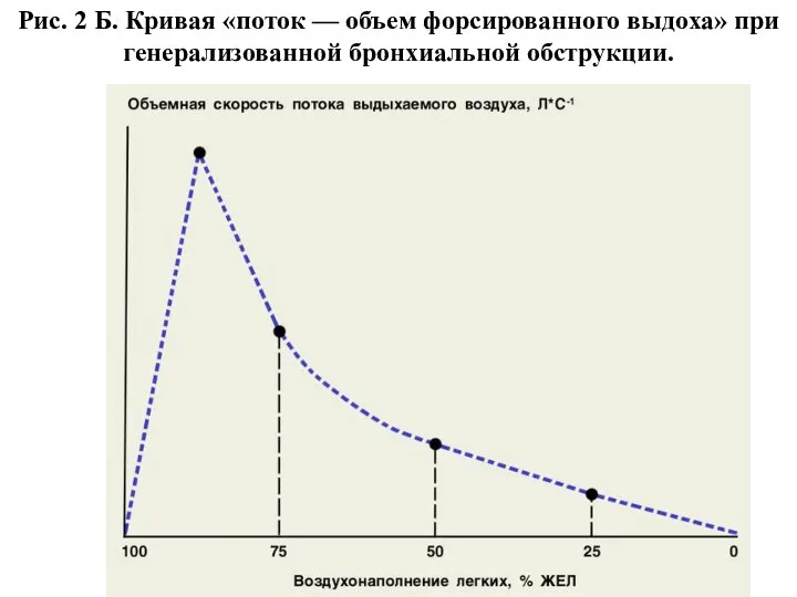 Рис. 2 Б. Кривая «поток — объем форсированного выдоха» при генерализованной бронхиальной обструкции.