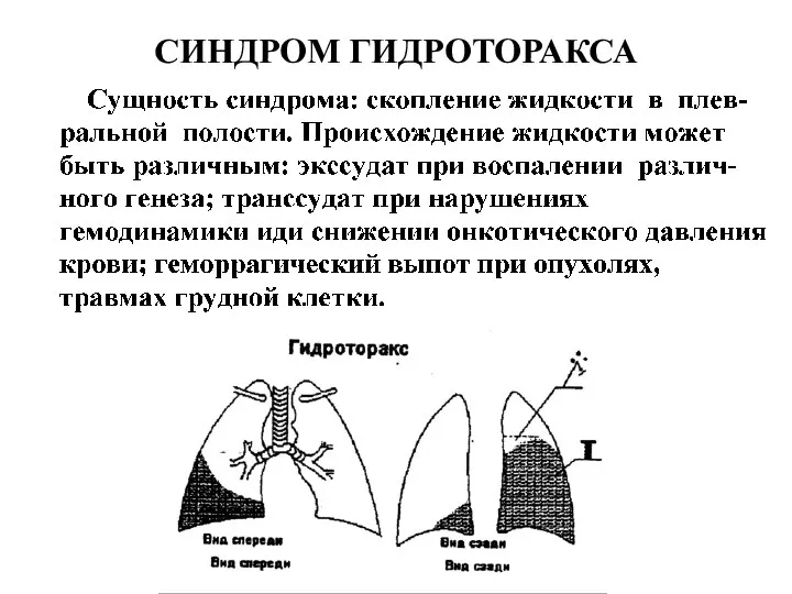 СИНДРОМ ГИДРОТОРАКСА