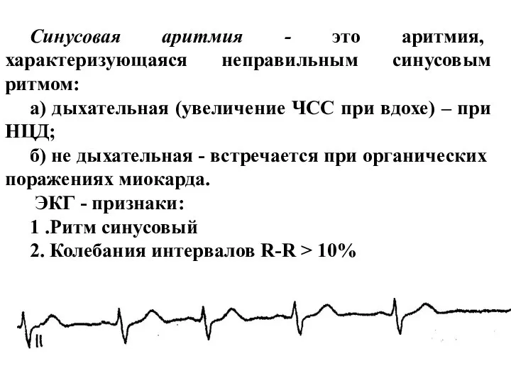 Синусовая аритмия - это аритмия, характеризующаяся неправильным синусовым ритмом: а) дыхательная
