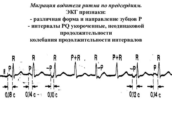 Миграция водителя ритма по предсердиям. ЭКГ признаки: - различная форма и