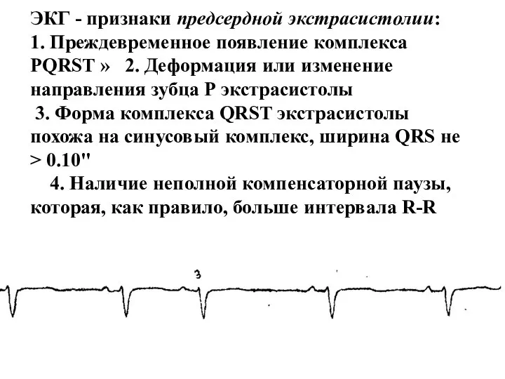 ЭКГ - признаки предсердной экстрасистолии: 1. Преждевременное появление комплекса PQRST »