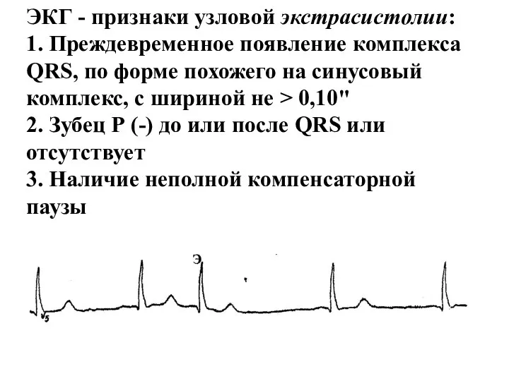 ЭКГ - признаки узловой экстрасистолии: 1. Преждевременное появление комплекса QRS, по