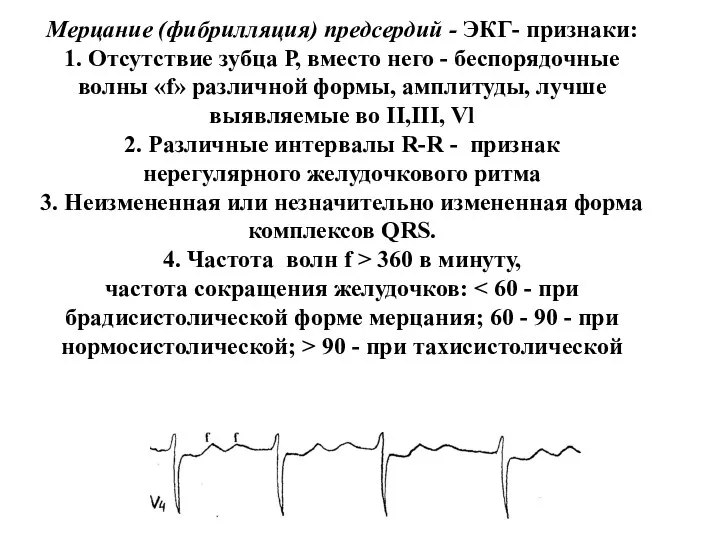 Мерцание (фибрилляция) предсердий - ЭКГ- признаки: 1. Отсутствие зубца Р, вместо