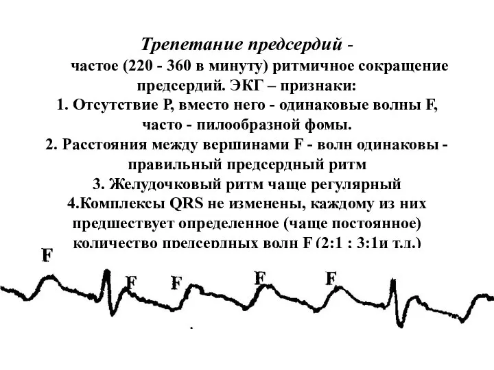 Трепетание предсердий - частое (220 - 360 в минуту) ритмичное сокращение