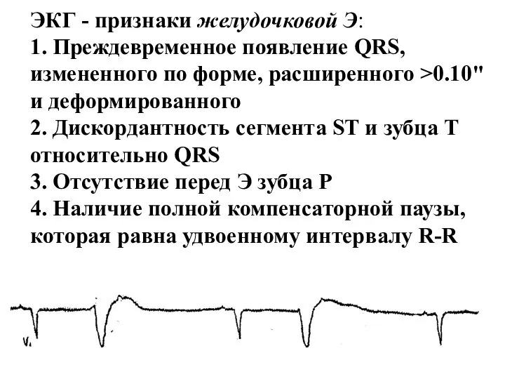 ЭКГ - признаки желудочковой Э: 1. Преждевременное появление QRS, измененного по