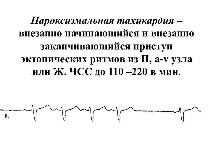 Пароксизмальная тахикардия – внезапно начинающийся и внезапно заканчивающийся приступ эктопических ритмов