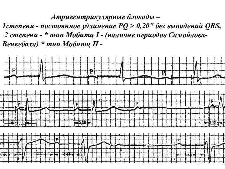 Атривентрикулярные блокады – 1степени - постоянное удлинение PQ > 0,20" без