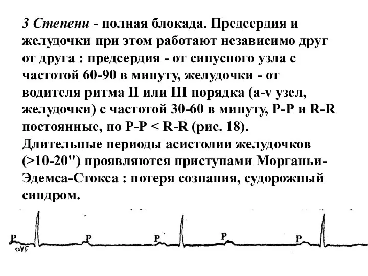 3 Степени - полная блокада. Предсердия и желудочки при этом работают