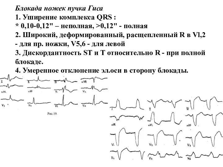 Блокада ножек пучка Гиса 1. Уширение комплекса QRS : * 0,10-0,12"