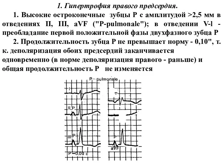 1. Гипертрофия правого предсердия. 1. Высокие остроконечные зубцы Р с амплитудой