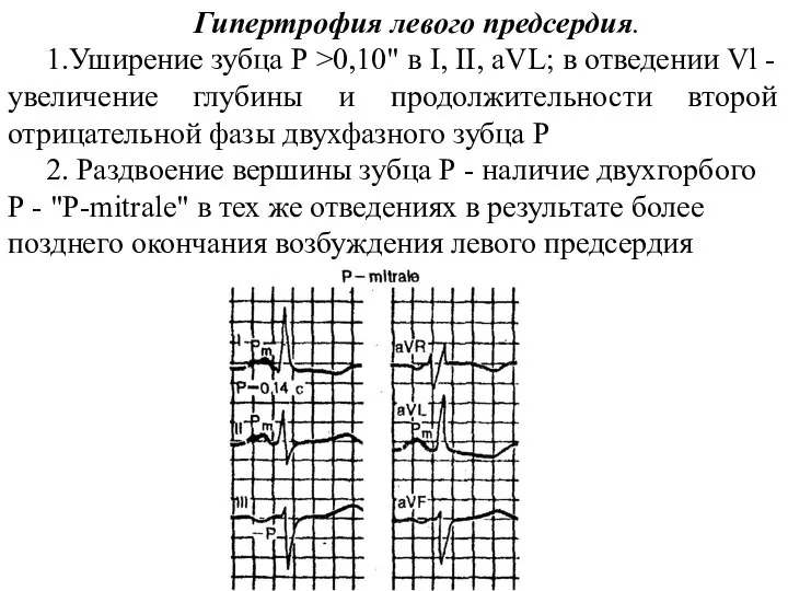 Гипертрофия левого предсердия. 1.Уширение зубца Р >0,10" в I, II, aVL;