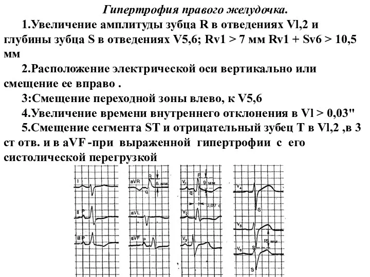 Гипертрофия правого желудочка. 1.Увеличение амплитуды зубца R в отведениях Vl,2 и