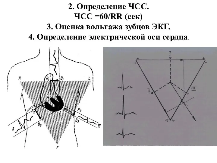 2. Определение ЧСС. ЧСС =60/RR (сек) 3. Оценка вольтажа зубцов ЭКГ. 4. Определение электрической оси сердца.