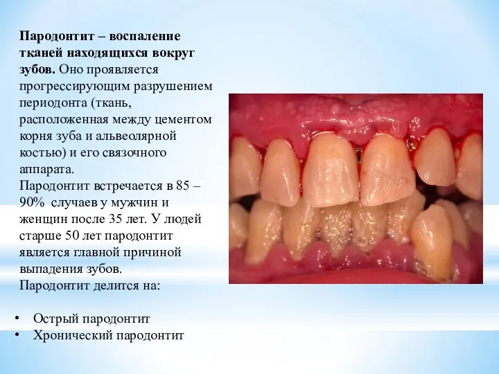 Пародонтит – воспаление тканей находящихся вокруг зубов. Оно проявляется прогрессирующим разрушением
