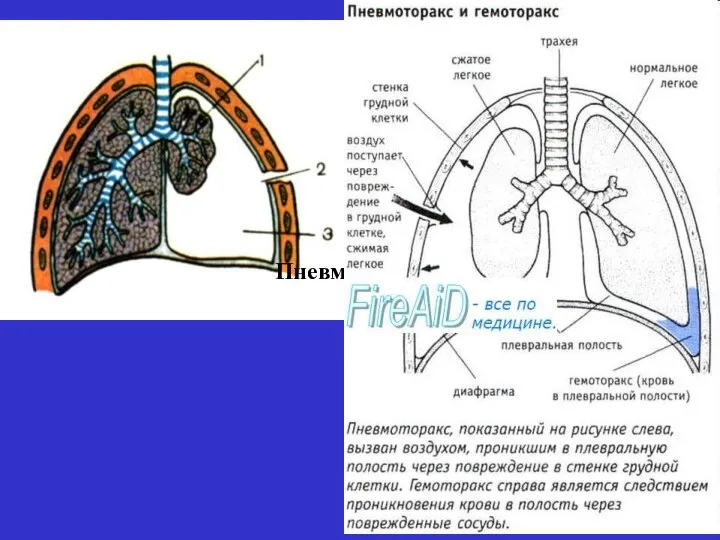 Пневмоторакс.