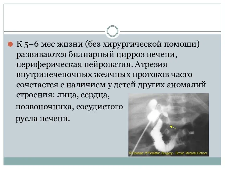 К 5–6 мес жизни (без хирургической помощи) развиваются билиарный цирроз печени,