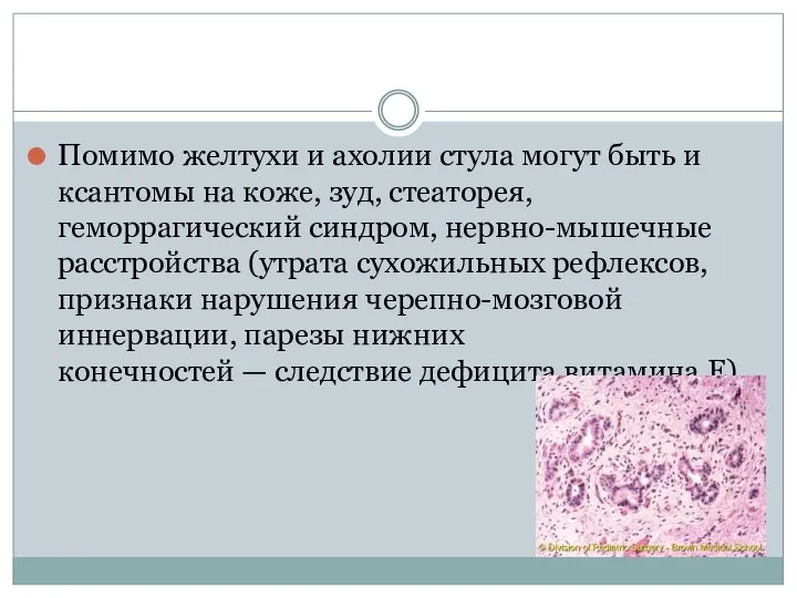 Помимо желтухи и ахолии стула могут быть и ксантомы на коже,