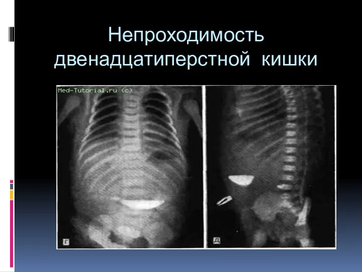 Непроходимость двенадцатиперстной кишки