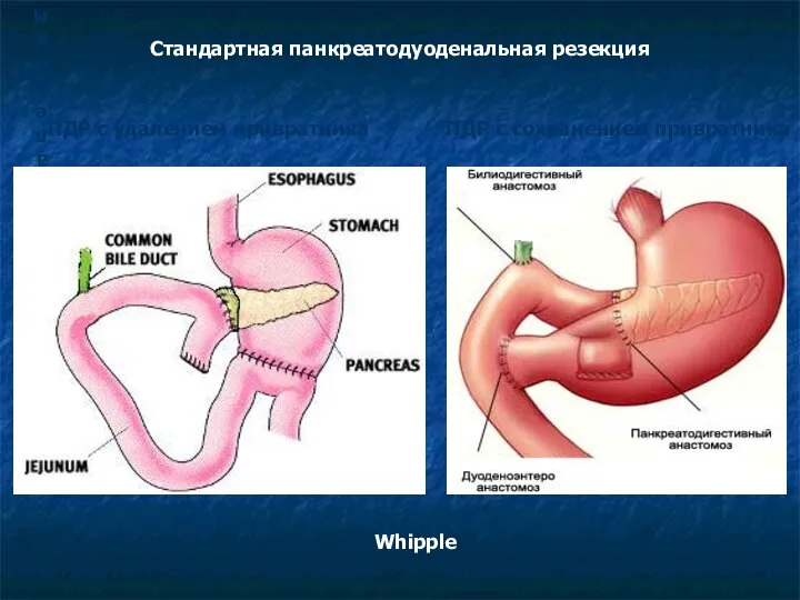 ПДР с удалением привратника Стандартная панкреатодуоденальная резекция ПДР с удалением привратника ПДР с сохранением привратника Whipple