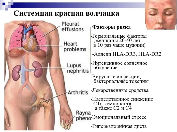 Системная красная волчанка Факторы риска Гормональные факторы (женщины 20-40 лет в