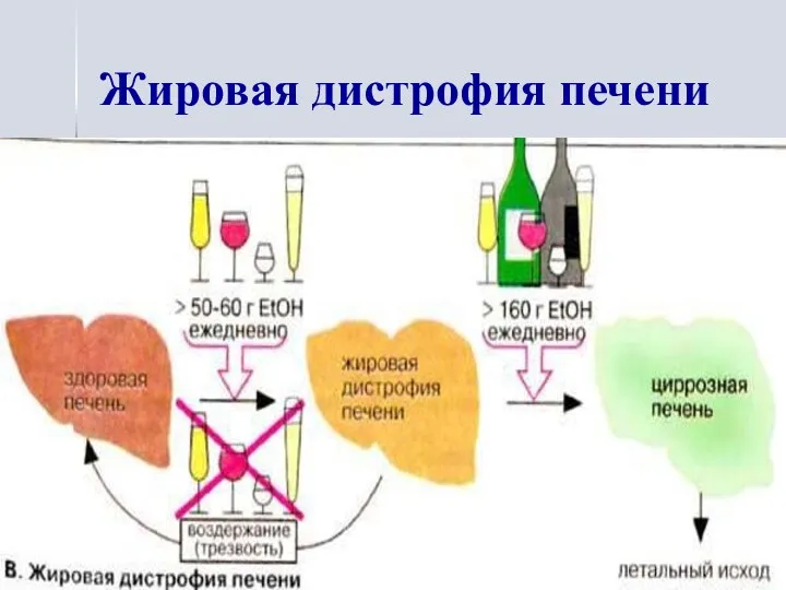 Жировая дистрофия печени