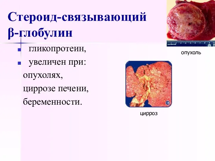 Стероид-связывающий β-глобулин гликопротеин, увеличен при: опухолях, циррозе печени, беременности. цирроз опухоль