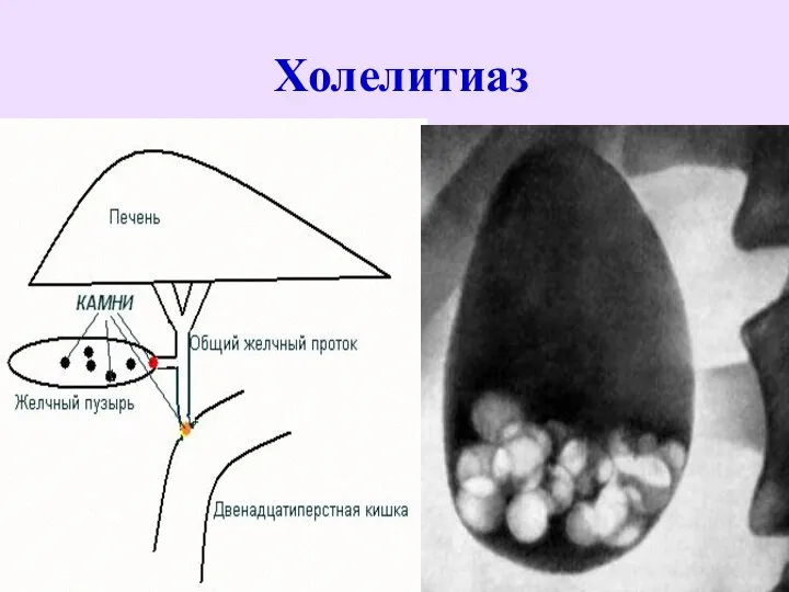 Холелитиаз