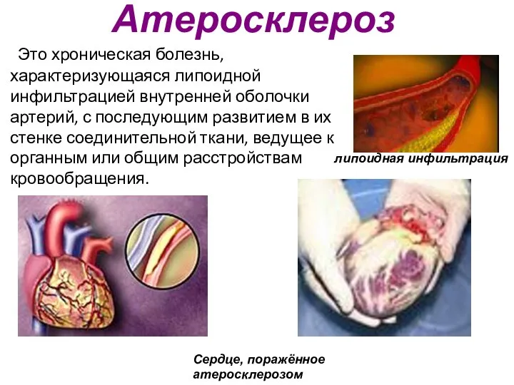 Атеросклероз Это хроническая болезнь, характеризующаяся липоидной инфильтрацией внутренней оболочки артерий, с