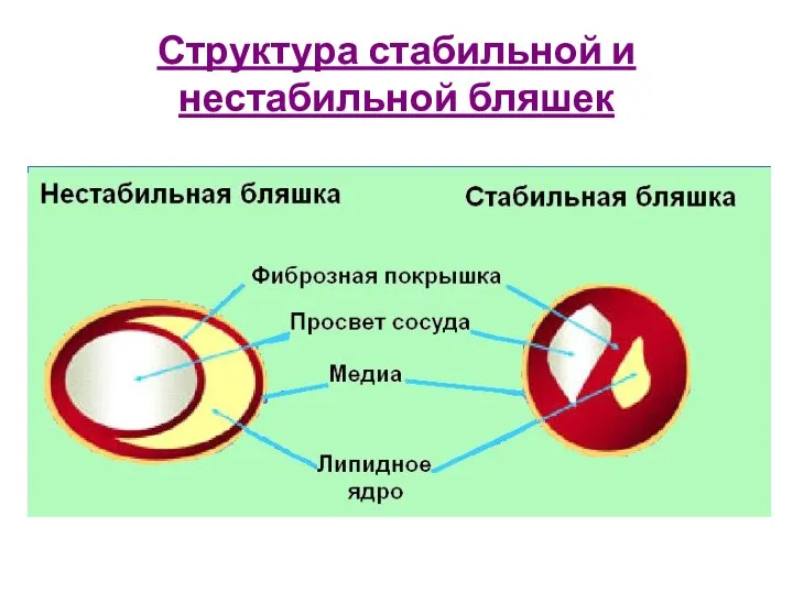 Структура стабильной и нестабильной бляшек