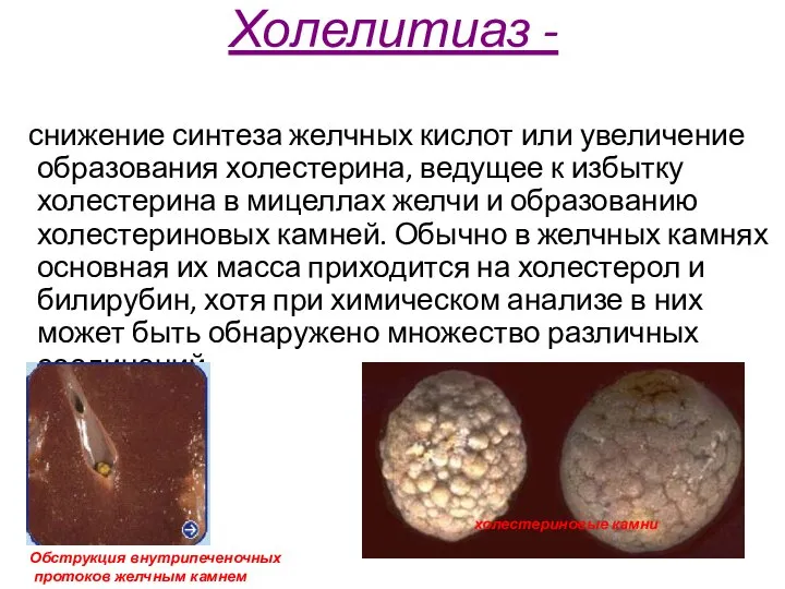 Холелитиаз - снижение синтеза желчных кислот или увеличение образования холестерина, ведущее