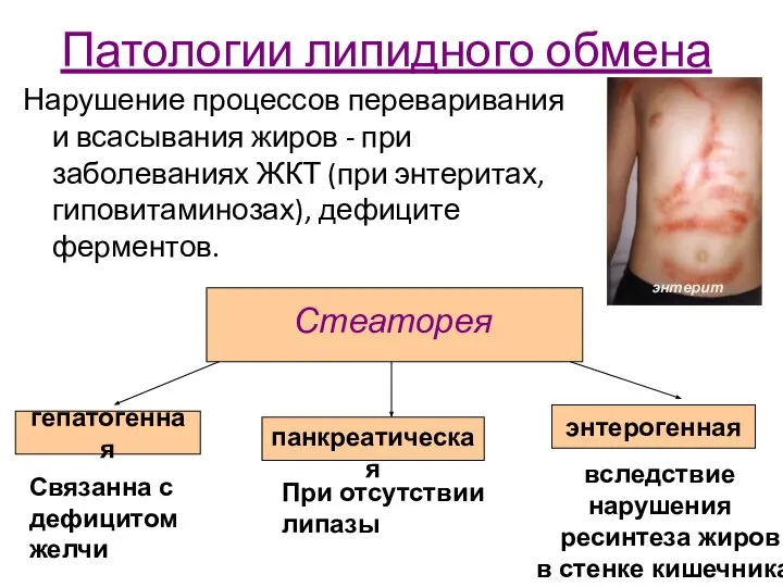 Патологии липидного обмена Нарушение процессов переваривания и всасывания жиров - при