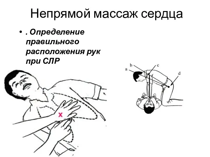 Непрямой массаж сердца . Определение правильного расположения рук при СЛР