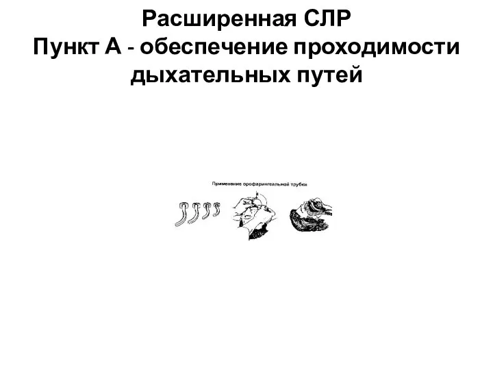 Расширенная СЛР Пункт А - обеспечение проходимости дыхательных путей