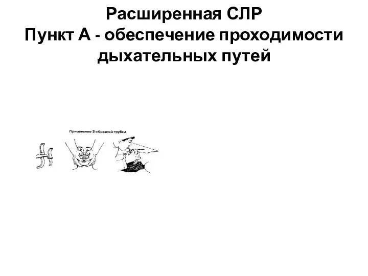 Расширенная СЛР Пункт А - обеспечение проходимости дыхательных путей