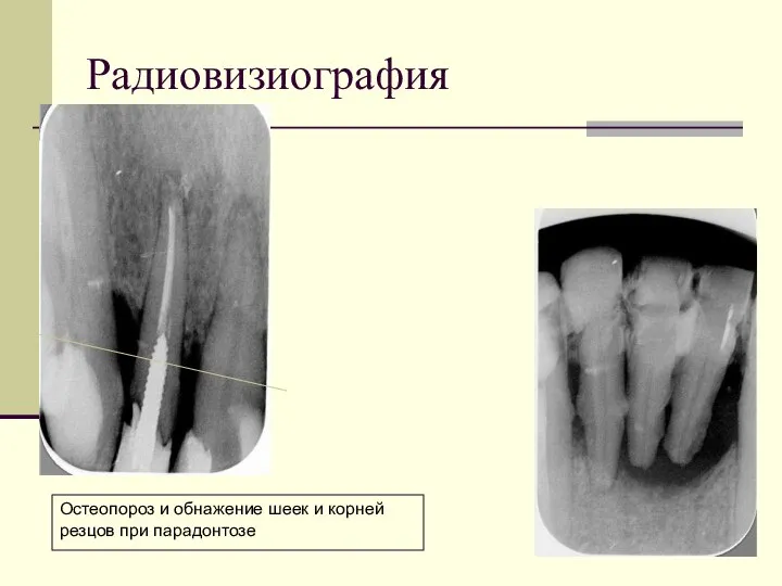 Радиовизиография Остеопороз и обнажение шеек и корней резцов при парадонтозе